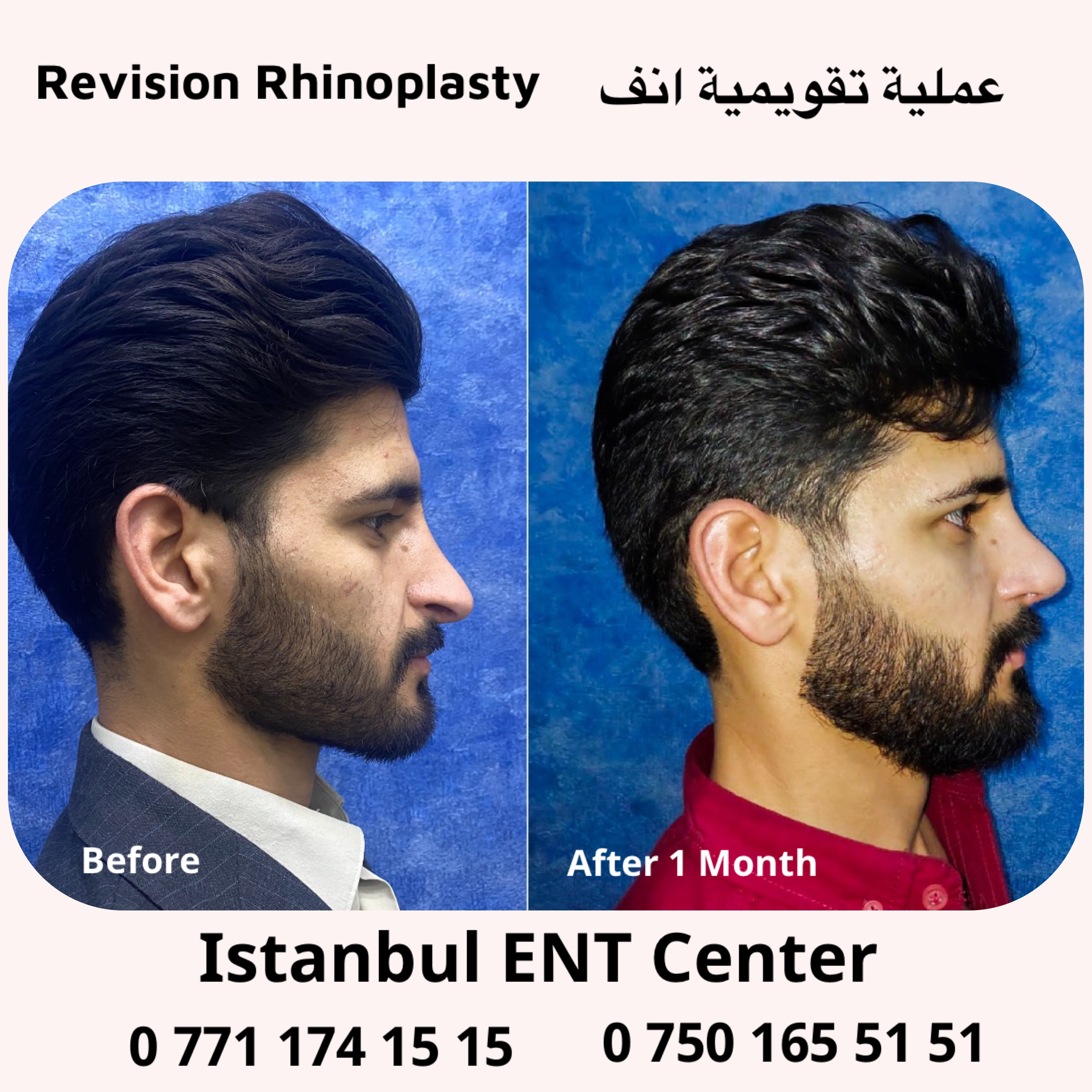 After a failed surgery in Iran left his nasal tip too long, Mr. Mervan's problem was corrected by Dr. Haluk.